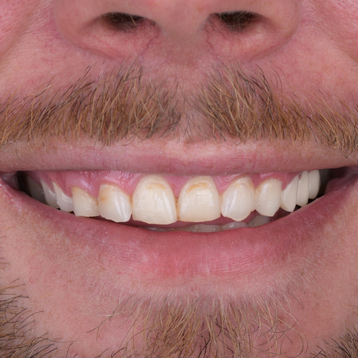 All-on-4 dental implants before and after photo of a full mouth restoration by Dr. Onur Ademhan