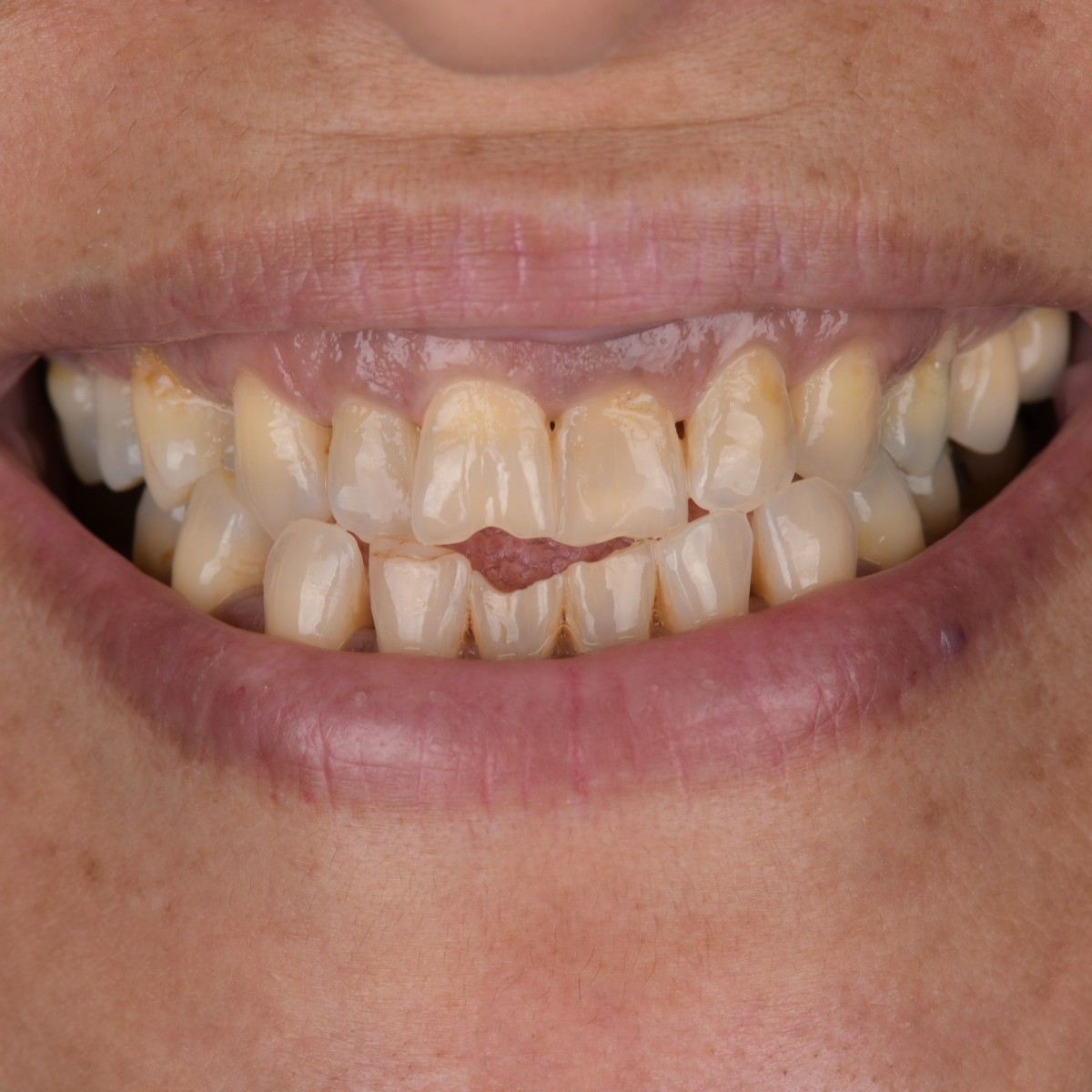 Before and after results of All-on-6 implant treatment for upper and lower jaw replacement