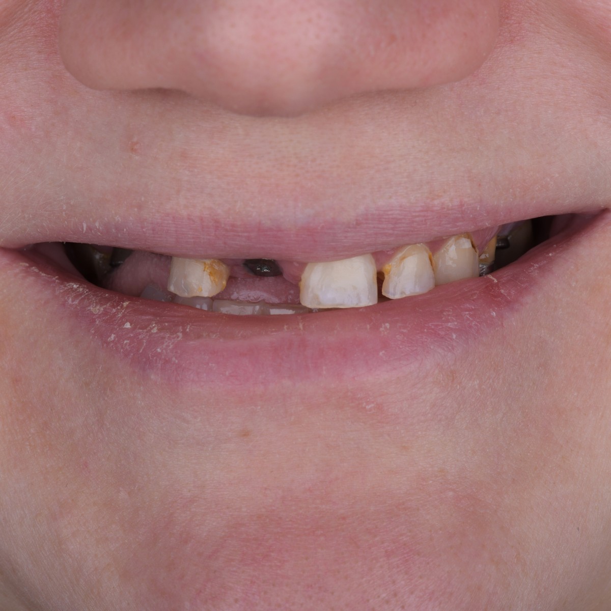 Smile transformation using dental implants patient treated by Dr. Onur Ademhan