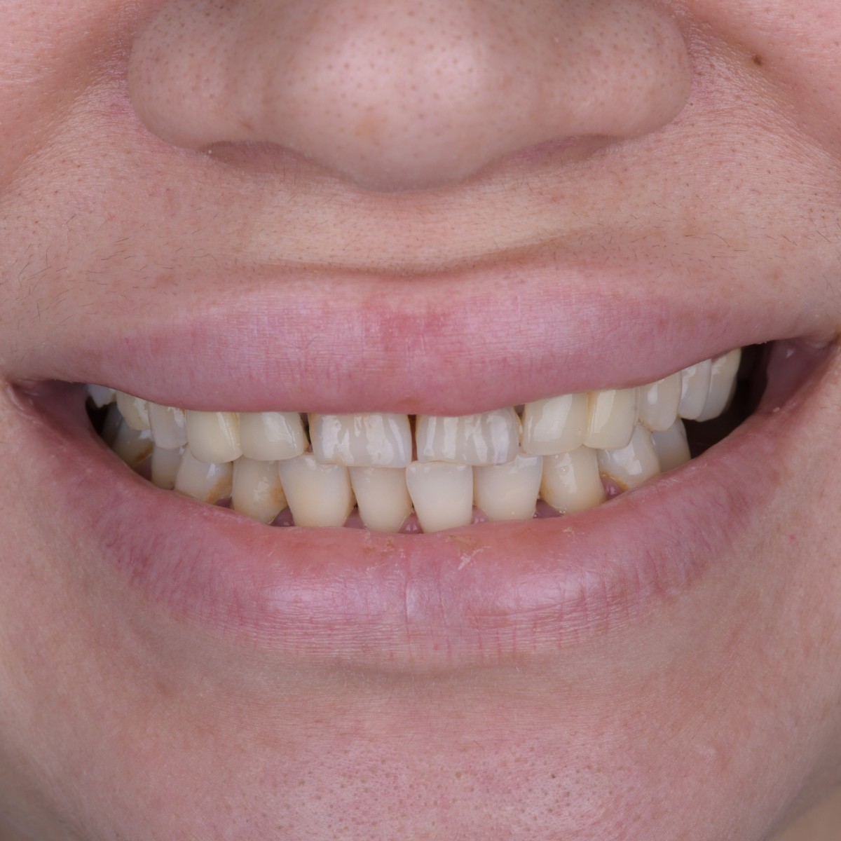 Before and after image showing improved aesthetics with dental implants