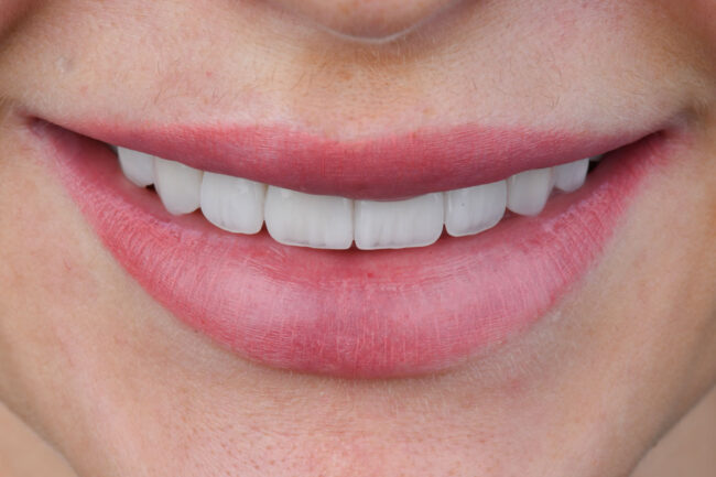 Antalya’da Emax veneer diş uygulaması Perla Dental Clinics’te estetik diş hekimi tarafından yapılıyor