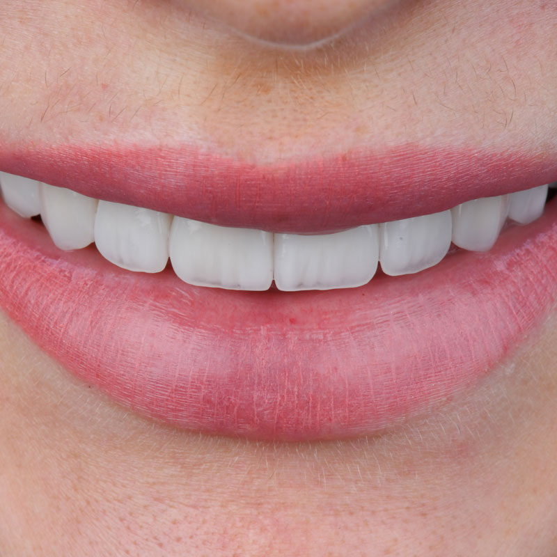 Antalya’da Emax veneer diş uygulaması Perla Dental Clinics’te estetik diş hekimi tarafından yapılıyor