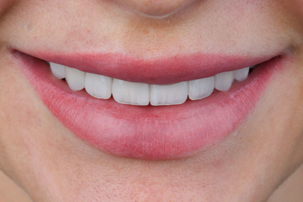 Patient-Emax-2 Antalya’da Emax veneer diş uygulaması Perla Dental Clinics’te estetik diş hekimi tarafından yapılıyor