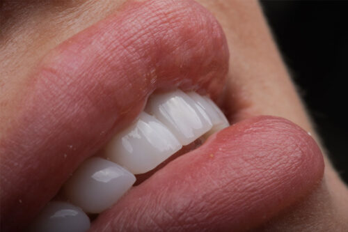 Emax veneer kaplama uygulaması Perla Dental Clinics Antalya’da estetik diş hekimi tarafından uygulanıyor