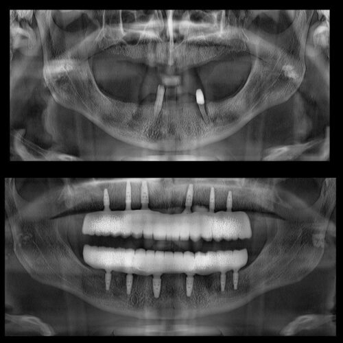 All-on-4 implant tedavisi öncesi ve sonrası gülüş farkı Perla Dental Clinics Antalya