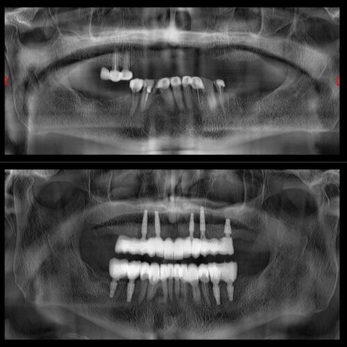 All-on-6 implant tedavisi için 3D planlama Perla Dental Clinics Antalya’da yapılıyor
