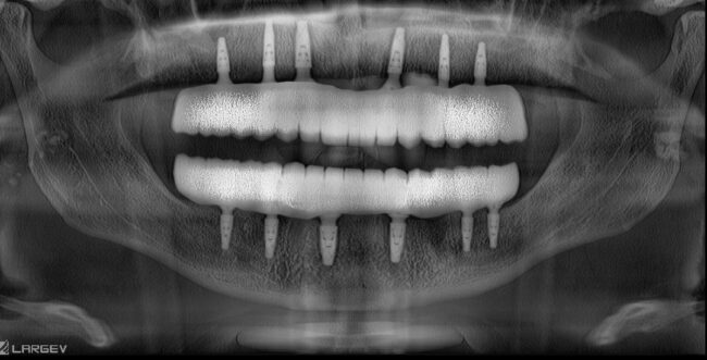 all-on-4 all-on-6 implant uygulaması Dr. Onur Ademhan tarafından Perla Dental Clinics’te gerçekleştiriliyor