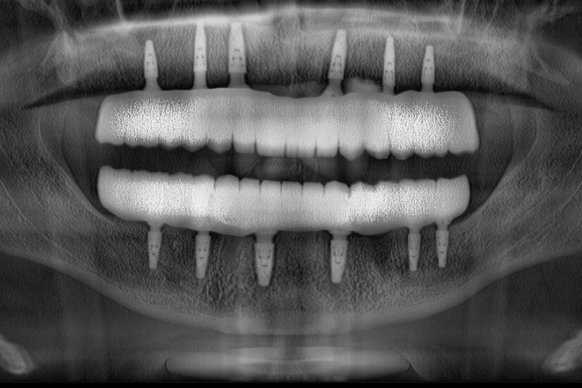 all-on-4-implant-antalya all-on-4 all-on-6 implant uygulaması Dr. Onur Ademhan tarafından Perla Dental Clinics’te gerçekleştiriliyor