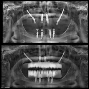 Zigoma implant X-ray by Dr. Onur Ademhan in Antalya showing implant placement in the cheekbone