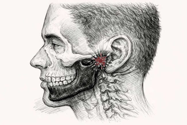 TMJ disorder treatment in Antalya by oral and maxillofacial surgeon Dr. Onur Ademhan