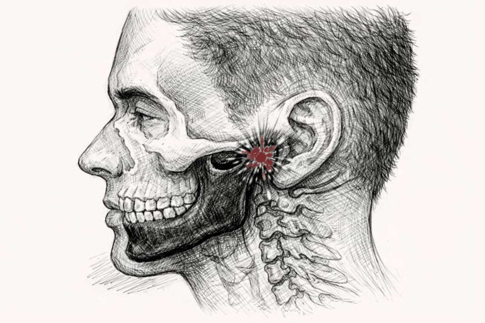 TMJ disorder treatment in Antalya by oral and maxillofacial surgeon Dr. Onur Ademhan