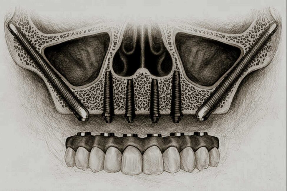 Zygomatic dental implant in antalya by dr. onur ademhan