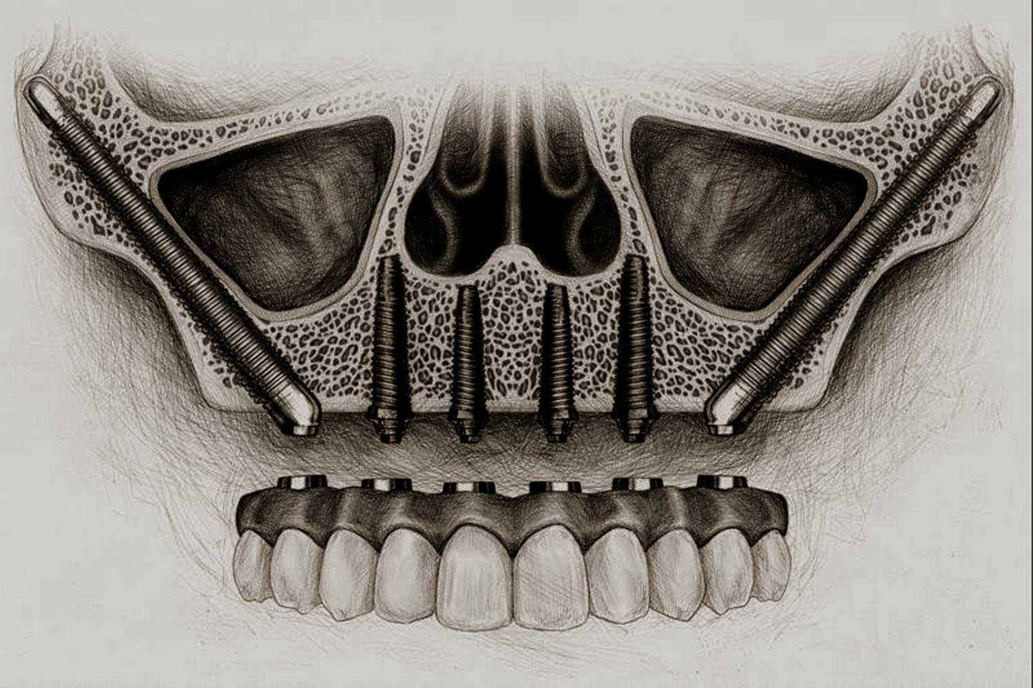 Zygomatic dental implant in antalya by dr. onur ademhan