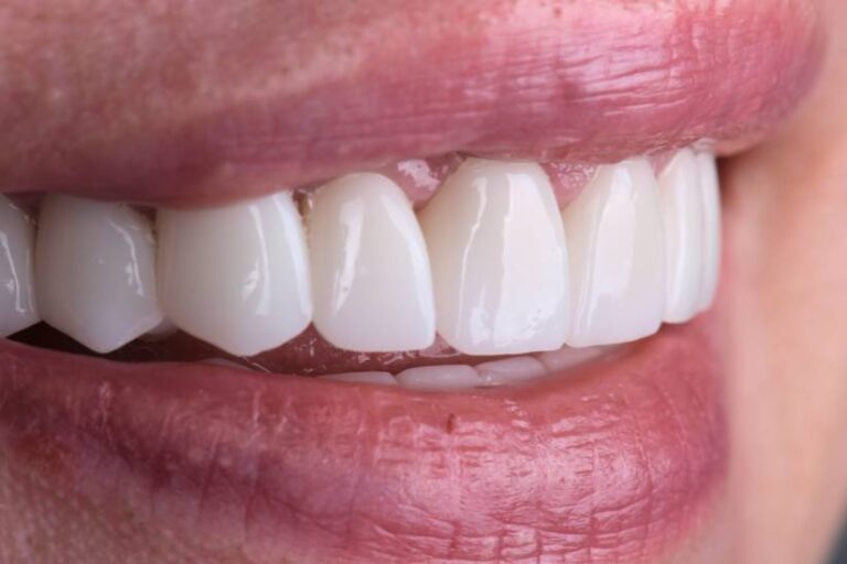 Dental vs Zygomatic Implants, Which One Is Right for You?