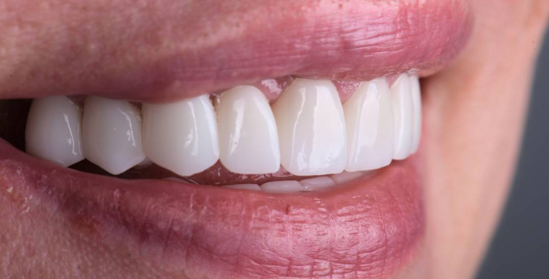 Dental vs Zygomatic Implants, Which One Is Right for You?