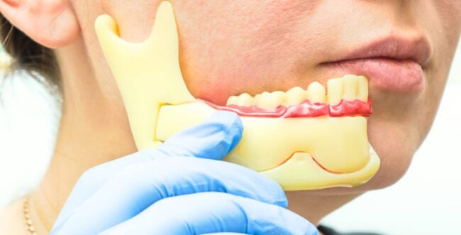 3D medical illustration of corrective jaw surgery in Antalya demonstrating jaw realignment by Dr. Onur Ademhan.