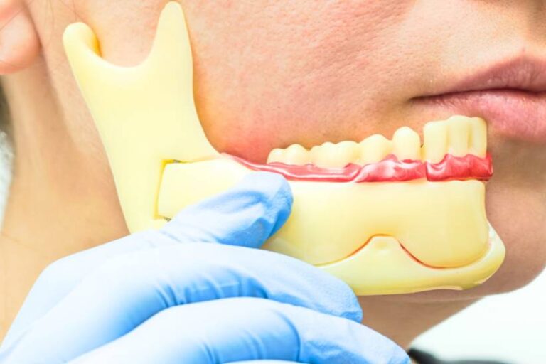 Corrective-jaw surgery-in-antalya-bg 3D medical illustration of corrective jaw surgery in Antalya demonstrating jaw realignment by Dr. Onur Ademhan.