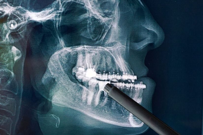 antalya-cene-duzeltme-ameliyati-3d-hizalama Antalya’da çene düzeltme ameliyatı öncesi ve sonrası çene hizalamasını gösteren 3D medikal görsel.