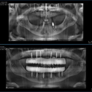 All on 6 implant tedavisi öncesi ve sonrası çene röntgeni