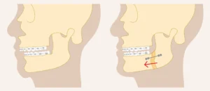çene düzeltme ameliyatı ortognatik cerrahi diyagramı