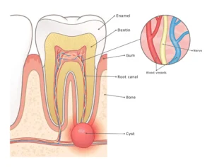 çene kemiğinde oluşan kist ve çene kisti diyagramı