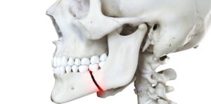 çene travması sonucu oluşan mandibula kırığı