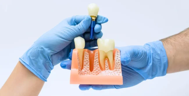 All-on-4 ve All-on-6 implant karşılaştırması ile tam ağız implant tedavisini