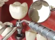 Comparison of All-on-4 vs All-on-6 implants showing full mouth restoration structure.