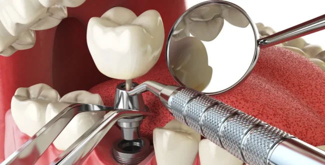 Comparison of All-on-4 vs All-on-6 implants showing full mouth restoration structure.