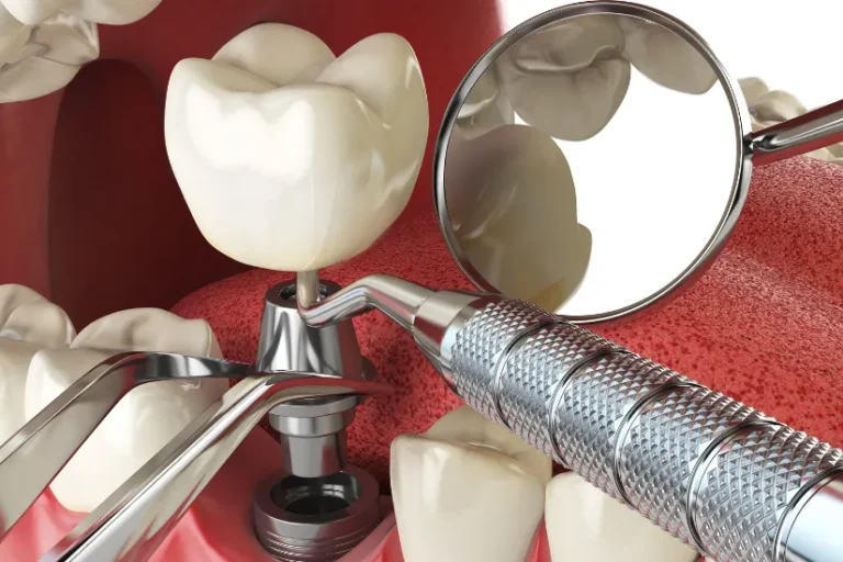 Comparison of All-on-4 vs All-on-6 implants showing full mouth restoration structure.