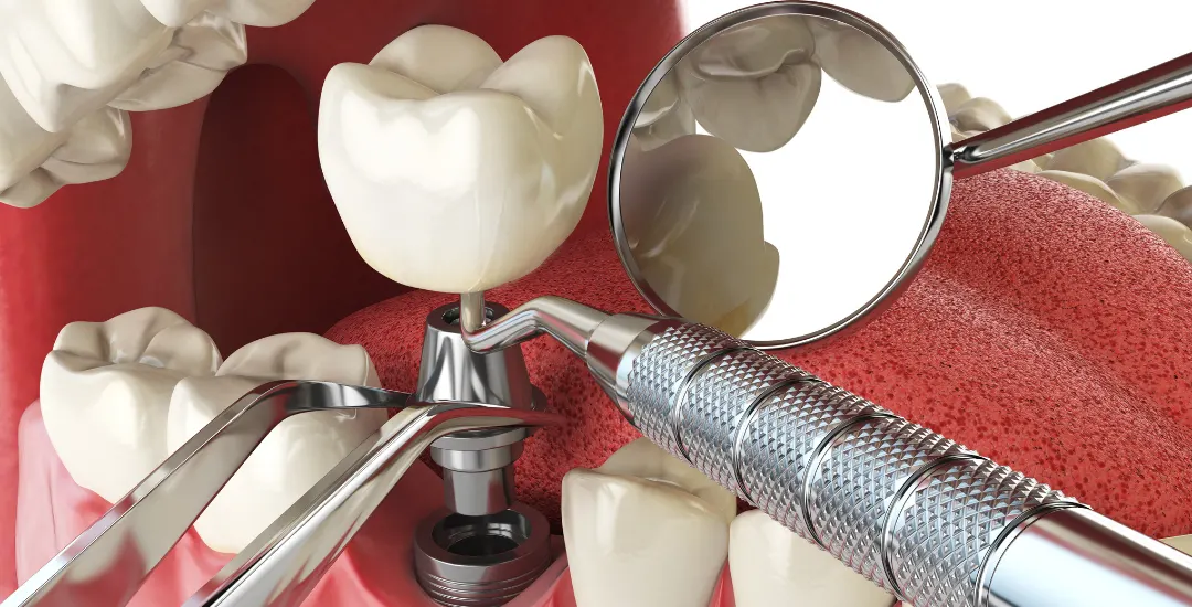 Comparison of All-on-4 vs All-on-6 implants showing full mouth restoration structure.