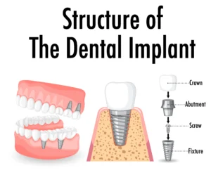 Structure of a dental implant showing crown, abutment and fixture used in full mouth dental implants.