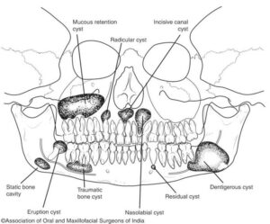 Types of jaw cysts in the jawbone including radicular, dentigerous and residual cysts