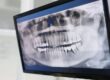 Can You Get Dental Implants Without Bone Grafting?