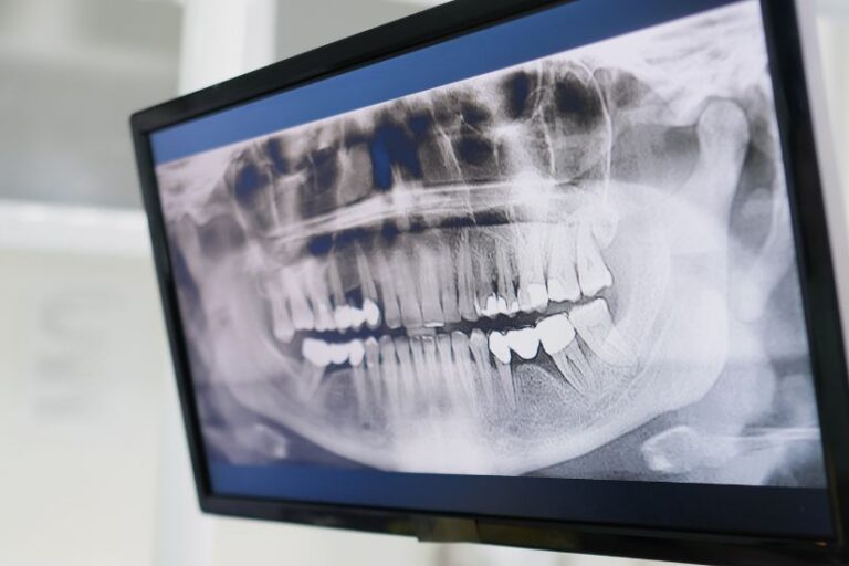 get-dental-implants-without-bone-grafting Can You Get Dental Implants Without Bone Grafting?