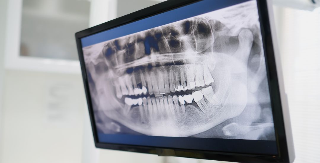 Can You Get Dental Implants Without Bone Grafting?