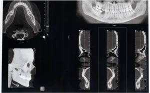 TMJ teşhisinde kullanılan çene ve eklem yapısını gösteren dental tomografi görüntüsü