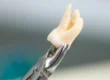 For the wisdom tooth extraction blog hero image, use this: Alt Text: Wisdom tooth extraction showing impacted third molar and oral surgery planning More natural version: Impacted wisdom tooth evaluation before wisdom tooth extraction SEO-focused version: Wisdom tooth extraction for impacted wisdom tooth with oral surgery evaluation My recommendation: Impacted wisdom tooth evaluation before wisdom tooth extraction. Dr. Onur Ademhan