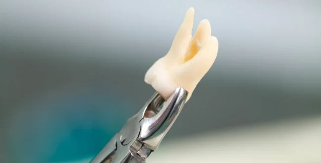 For the wisdom tooth extraction blog hero image, use this: Alt Text: Wisdom tooth extraction showing impacted third molar and oral surgery planning More natural version: Impacted wisdom tooth evaluation before wisdom tooth extraction SEO-focused version: Wisdom tooth extraction for impacted wisdom tooth with oral surgery evaluation My recommendation: Impacted wisdom tooth evaluation before wisdom tooth extraction. Dr. Onur Ademhan