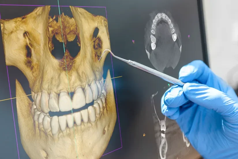 çene kemiği kisti nedir Çene kemiği kisti teşhisi için panoramik röntgen değerlendirmesi, dr onur ademhan