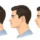 Underbite and overbite comparison showing jaw misalignment and bite differences, dr onur ademhan