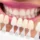 Turkey teeth smile makeover, veneers and dental crowns.