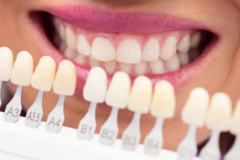what are turkey teeth Turkey teeth smile makeover, veneers and dental crowns.