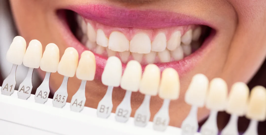 what are turkey teeth Turkey teeth smile makeover, veneers and dental crowns.